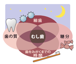 虫歯になる4条件