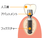 インプラント治療について