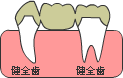 歯が中間で１本抜けた場合