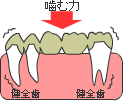 歯が中間で１本抜けた場合