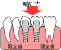 歯が中間で１本抜けた場合