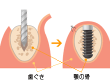 一次手術