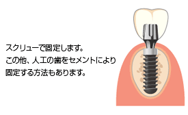 人工の歯を作製・装着