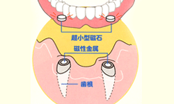 マグフィット（磁石式入れ歯）