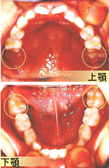 はじめての大人の歯 6歳臼歯 小児歯科 宇都宮 雀宮 矯正歯科 歯医者 那須歯科医院 インプラント